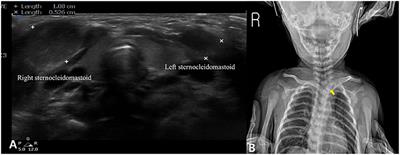 Concurrence of Congenital Muscular Torticollis and Congenital Torticollis Due to Other Anomalies: Two Case Reports